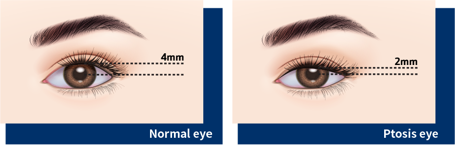 irregular pupil shape correction on its own